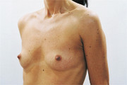 Before Treatment